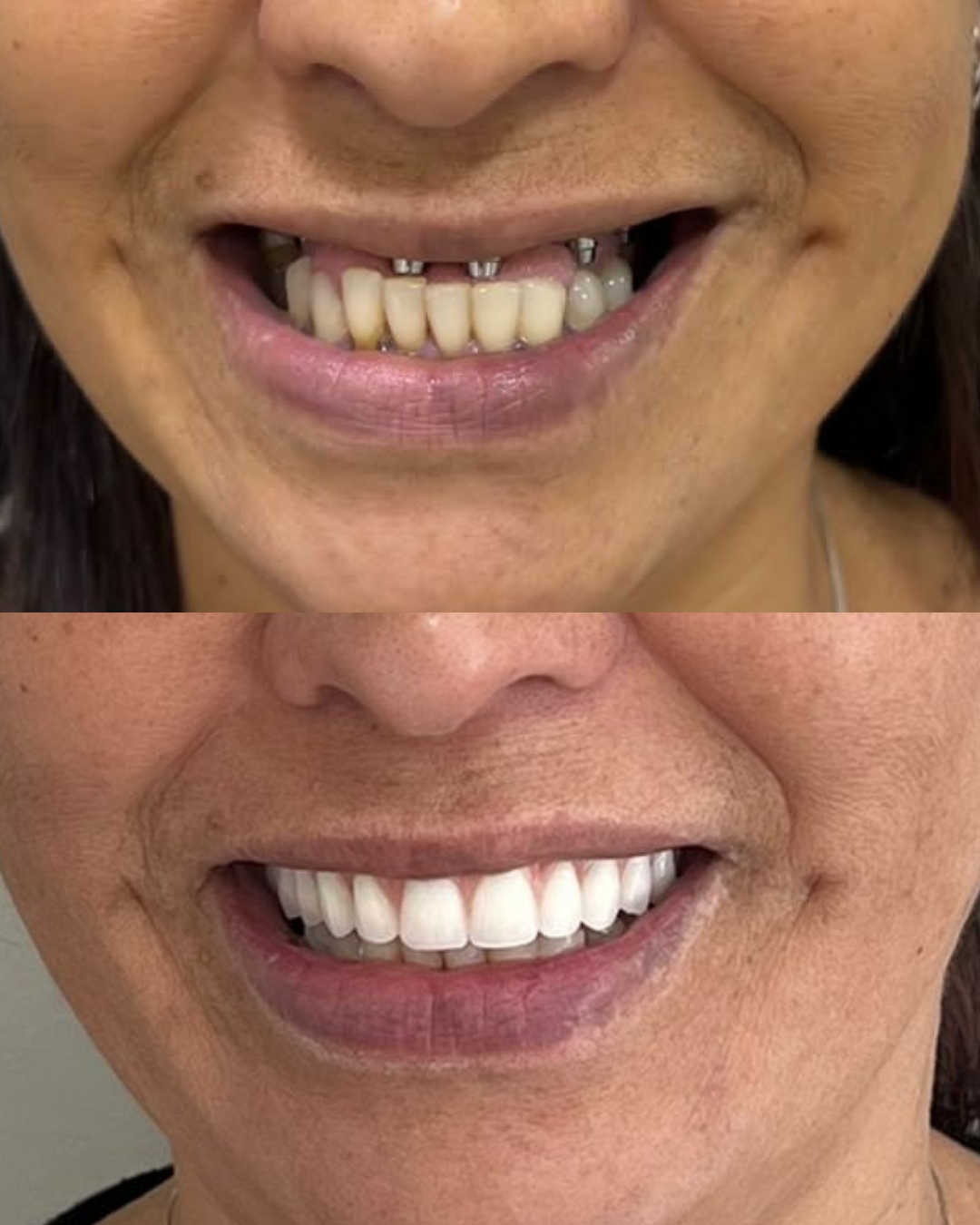 Antes e Depois Implante Dentário Curitiba