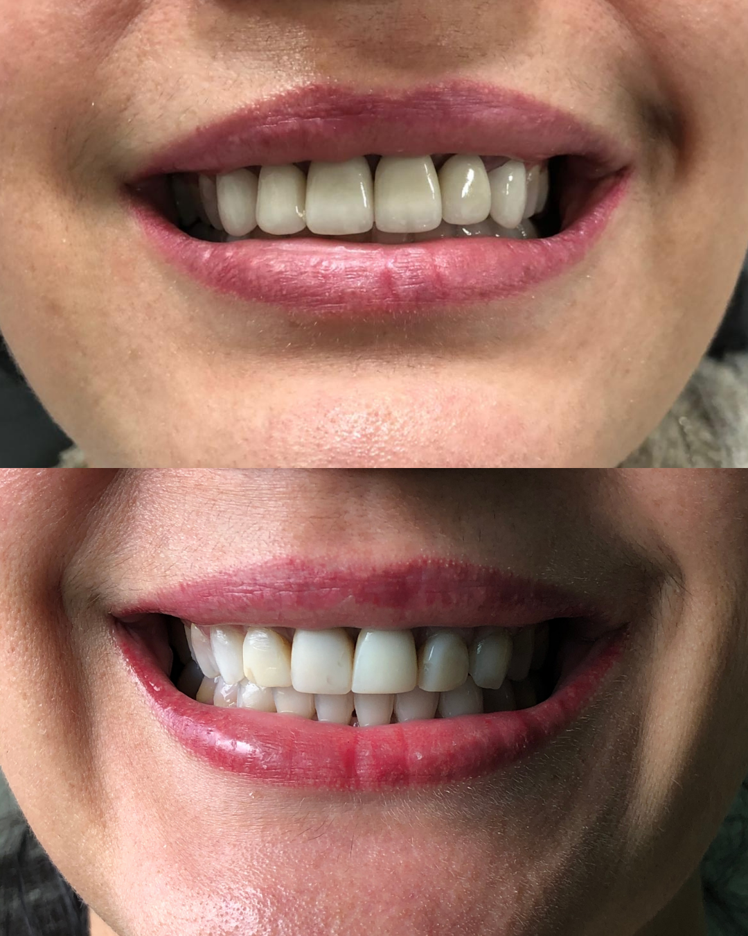 Transformação Sorriso com Implante Curitiba