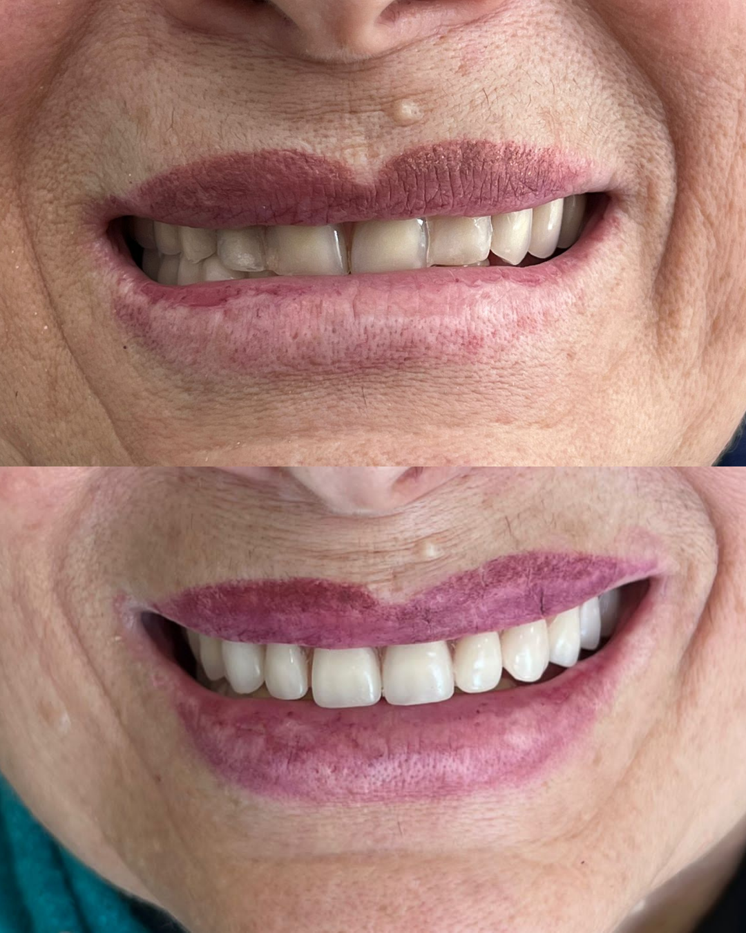 Implante Dentário Curitiba Resultado Final